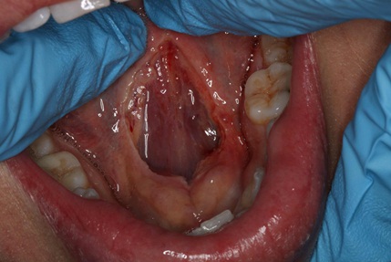 Adult tongue tie surgery with laser.