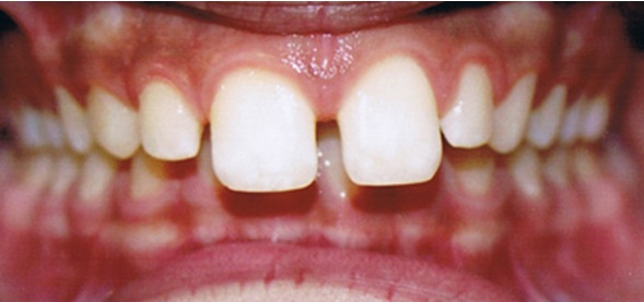 Class II Malocclusion