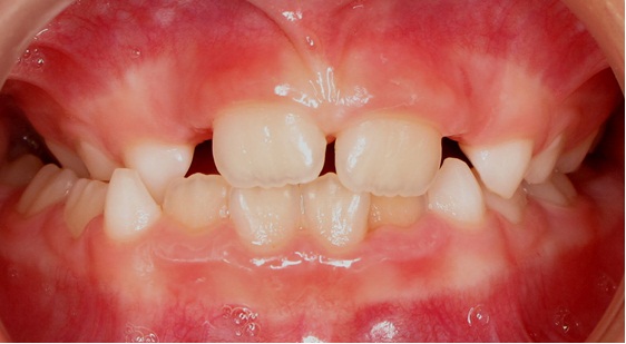 Posterior Cross Bite