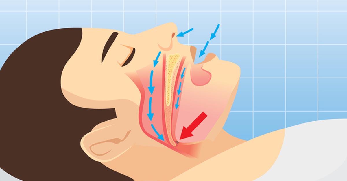 Mouth breathing can be harmful for your teeth and may lead to serious health issues