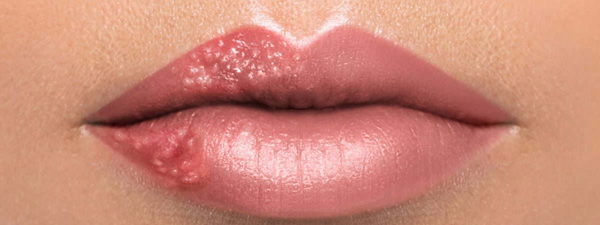 Canker Sores vs. Cold Sores: Causes and Natural Cures